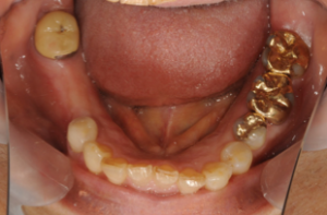 ノンクラスプデンチャーの症例 | 浜松町・竹芝の歯医者なら浜松町歯科・矯正治療院