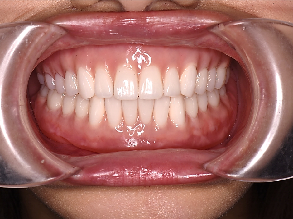 総入れ歯は咬合や審美性を最適化できる