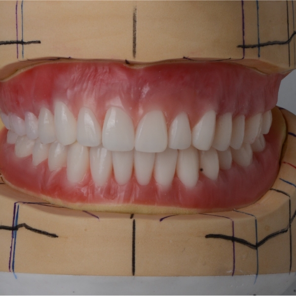 人工歯の排列