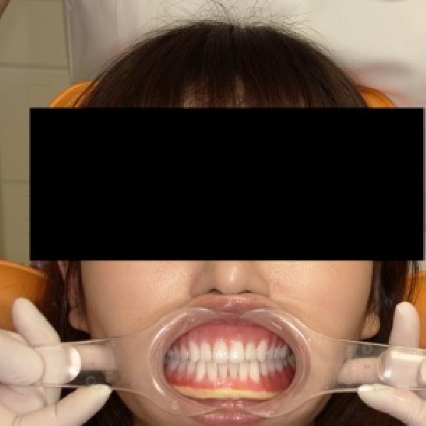 人工歯の排列
