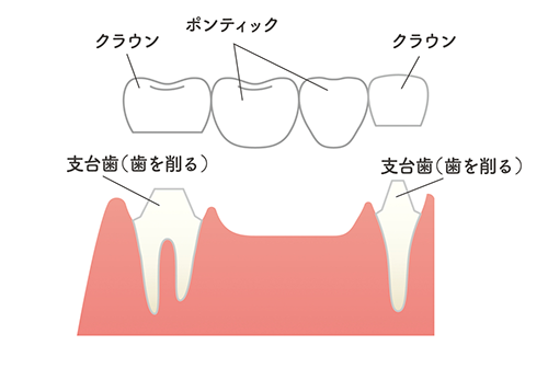 ブリッジ