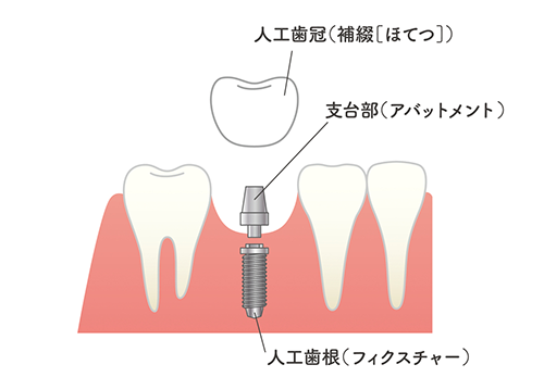 インプラント