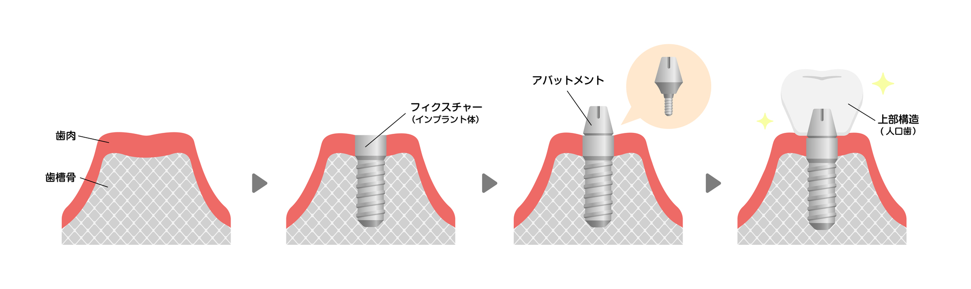 インプラント治療の流れ