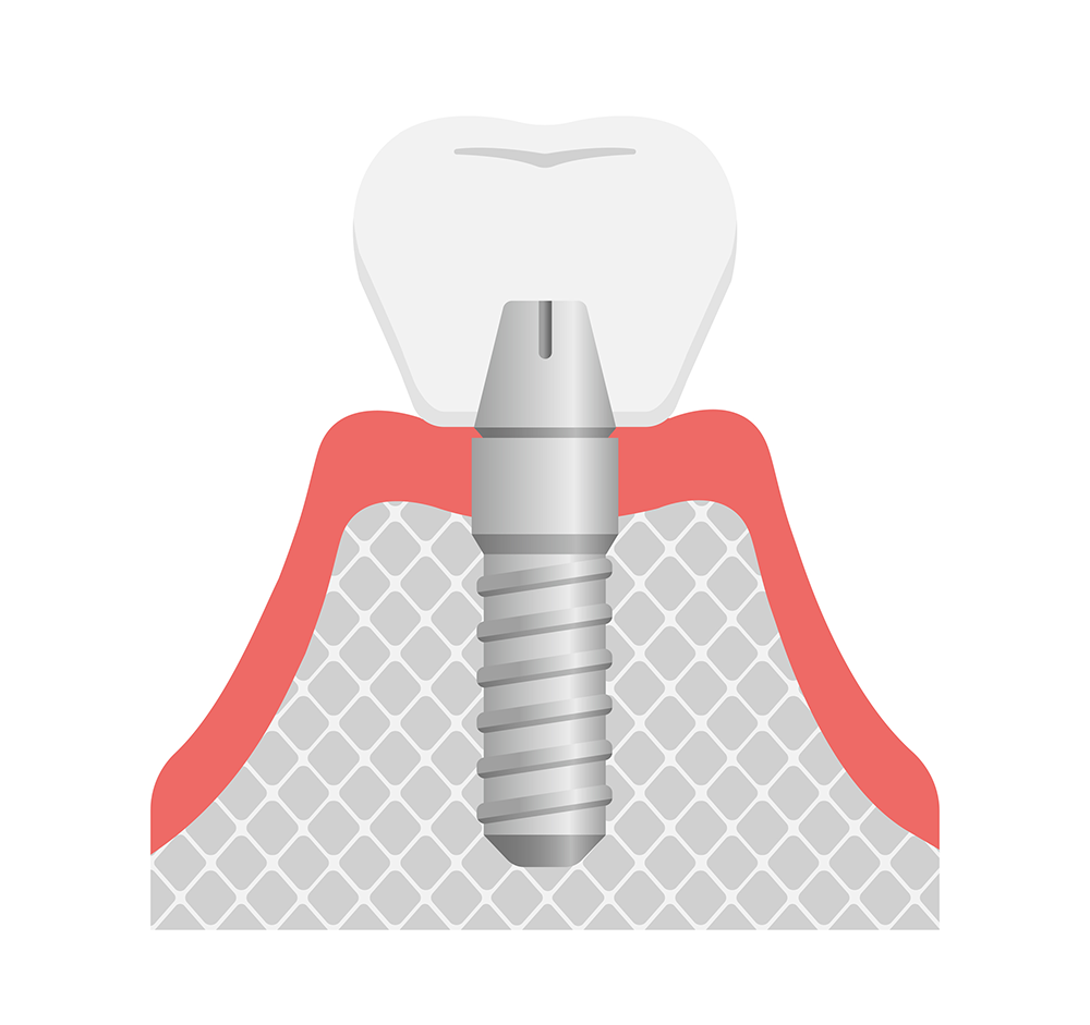 インプラント
