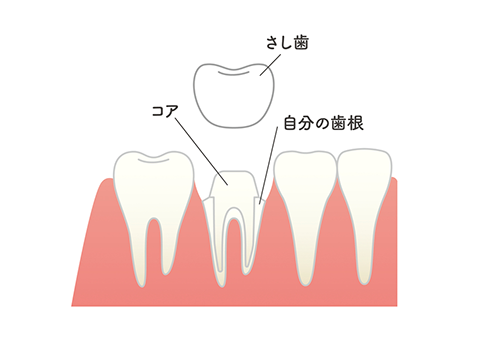 差し歯