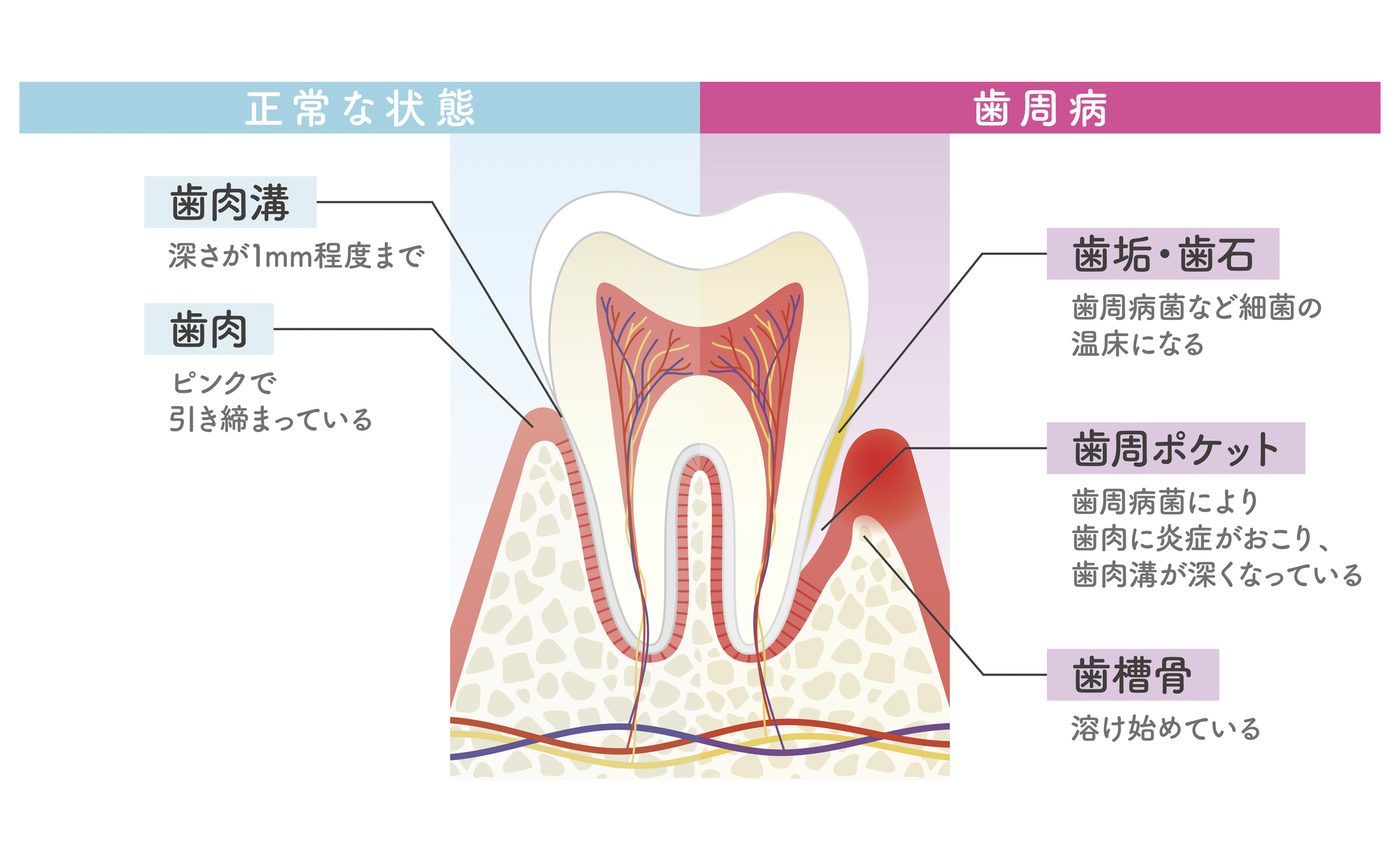 歯周病