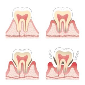 歯周病