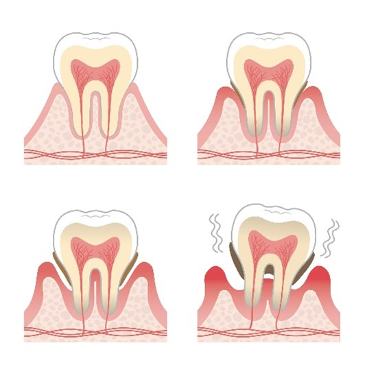 歯周病